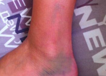 Conseil trail : quelle chaussure avec un très bon maintien de la cheville