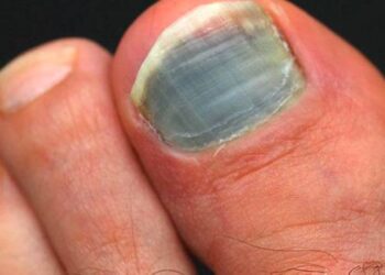 pieds trail ongles noirs sport trail