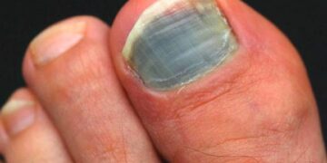 pieds trail ongles noirs sport trail