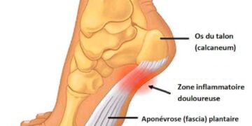 aponévrosite plantaire