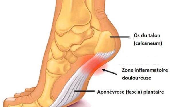 Comment courir avec une apon vrosite plantaire u Trail