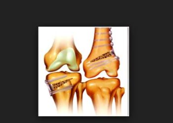 chaussures de trail ostéotomie du genou