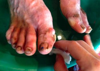 soin pied ultra trail