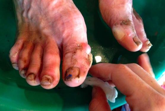 soin pied ultra trail