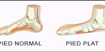 Comment choisir ses chaussures de trail quand on a les pieds plats