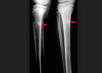 Entrainement : comment reprendre après une  fracture de fatigue tibiale