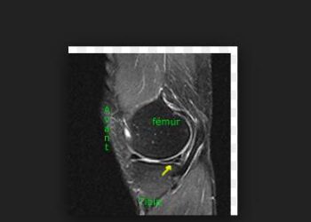 fissure menisque genou trail