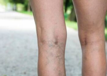 3 astuces pour s’entrainer malgré une insuffisance veineuse