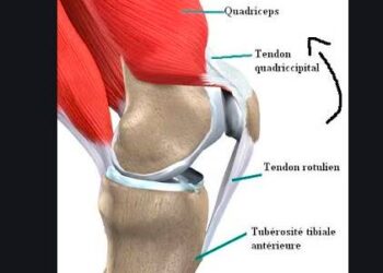 Inflammation du tendon quadricipital rotulien