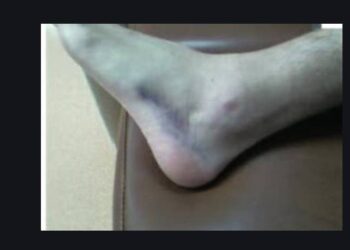 Question trail sur la douleur aux extenseurs des orteils