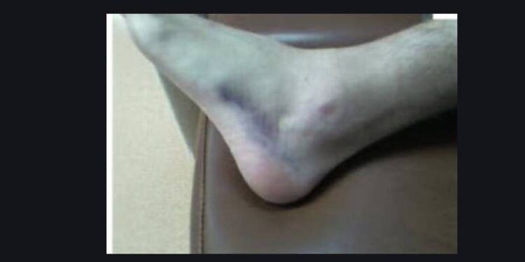 Question trail sur la douleur aux extenseurs des orteils