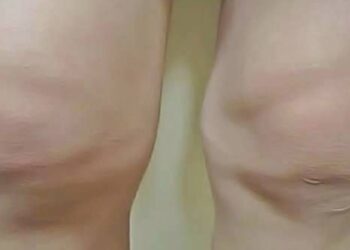 épanchement de synovie