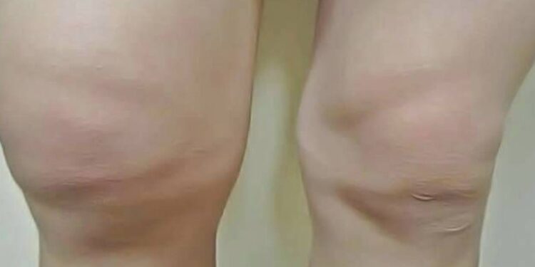 épanchement de synovie