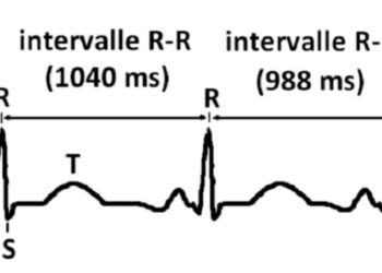 variabilité fréquence cardiaque
