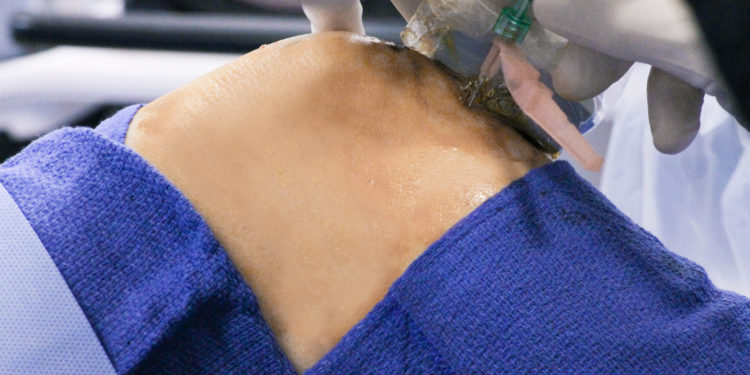 injections PRP trail