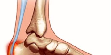 bursite rétrocalcanéenne