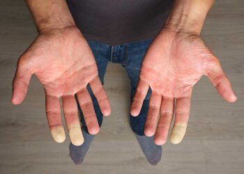 Trail & syndrome de Raynaud