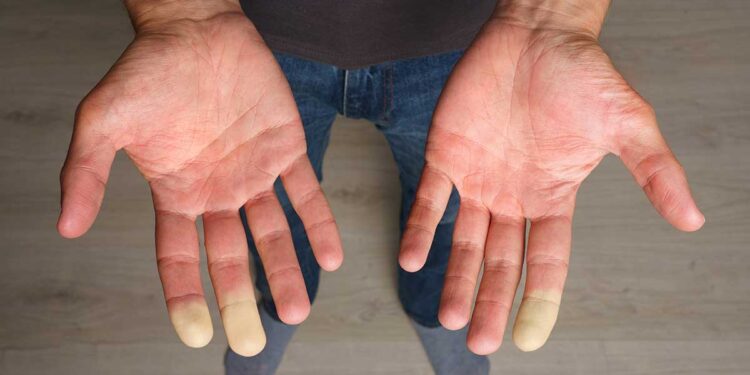 Trail & syndrome de Raynaud