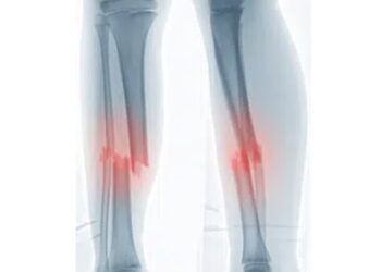 fracture ouverte aux 2 tibias