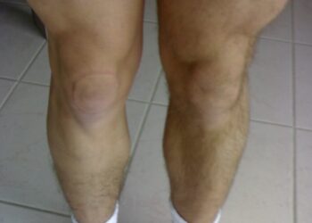 rupture du ligament croisé antérieur