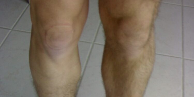 rupture du ligament croisé antérieur