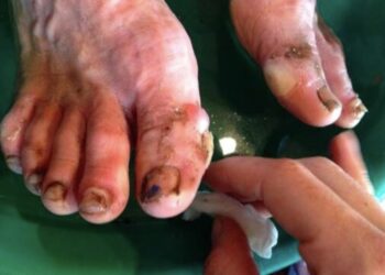 Ultra-trail : notre protocole pour prendre soin de vos pieds…