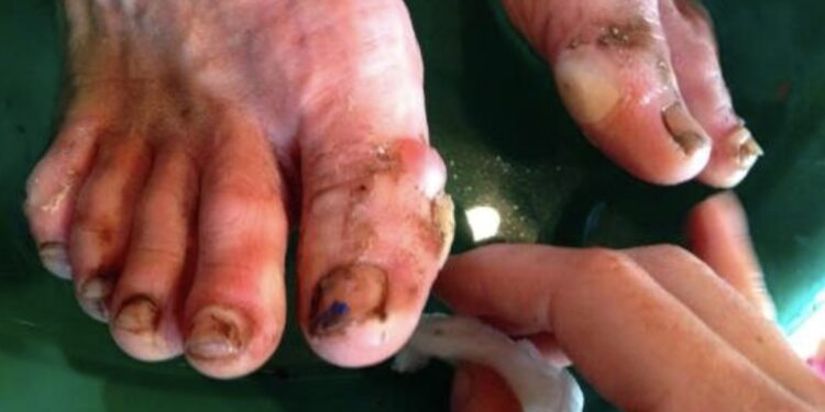 Ultra-trail : notre protocole pour prendre soin de vos pieds…