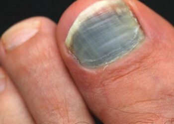 Sur l’UTMB : 10% des abandons viennent des problèmes de pieds/ongles