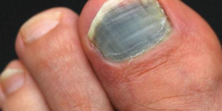 Sur l’UTMB : 10% des abandons viennent des problèmes de pieds/ongles