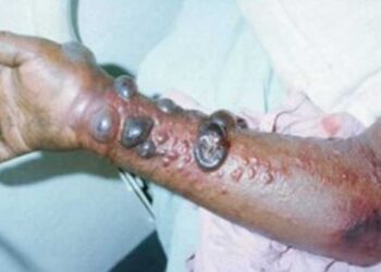 fièvre hemorragique tiques