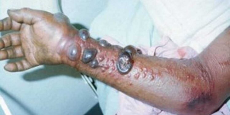 fièvre hemorragique tiques