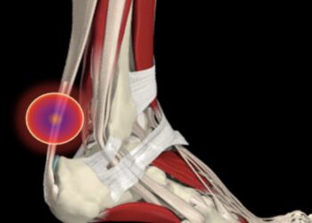 chaussure trail tendon d'achille