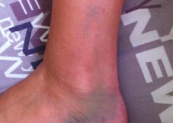 Quelles chaussures de trail pour des chevilles et des genoux fragiles ?