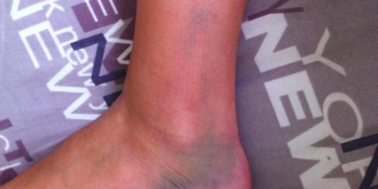 Quelles chaussures de trail pour des chevilles et des genoux fragiles ?