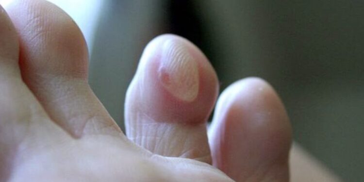 ampoules pieds