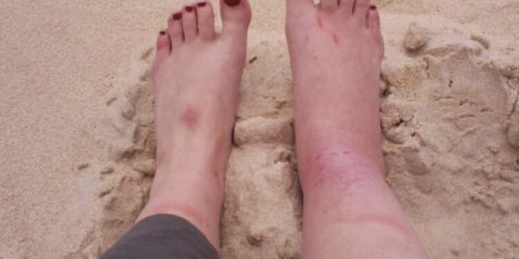 pieds gonflés après un ultra-trail